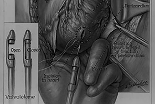 An illustration of a heart procedure using a valvulotome is pictured.