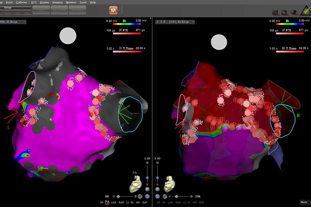Biosense images of Albert Litster's heart